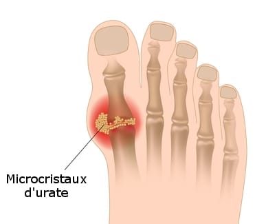 Goutte : comment prévenir et soulager les crises de goutte