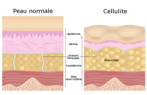 schema_cellulite