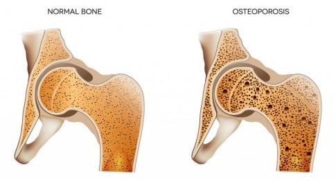 osteoporose_illustration_135507929