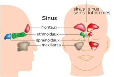 Sinusite : quand la sinusite montre le bout de son nez !