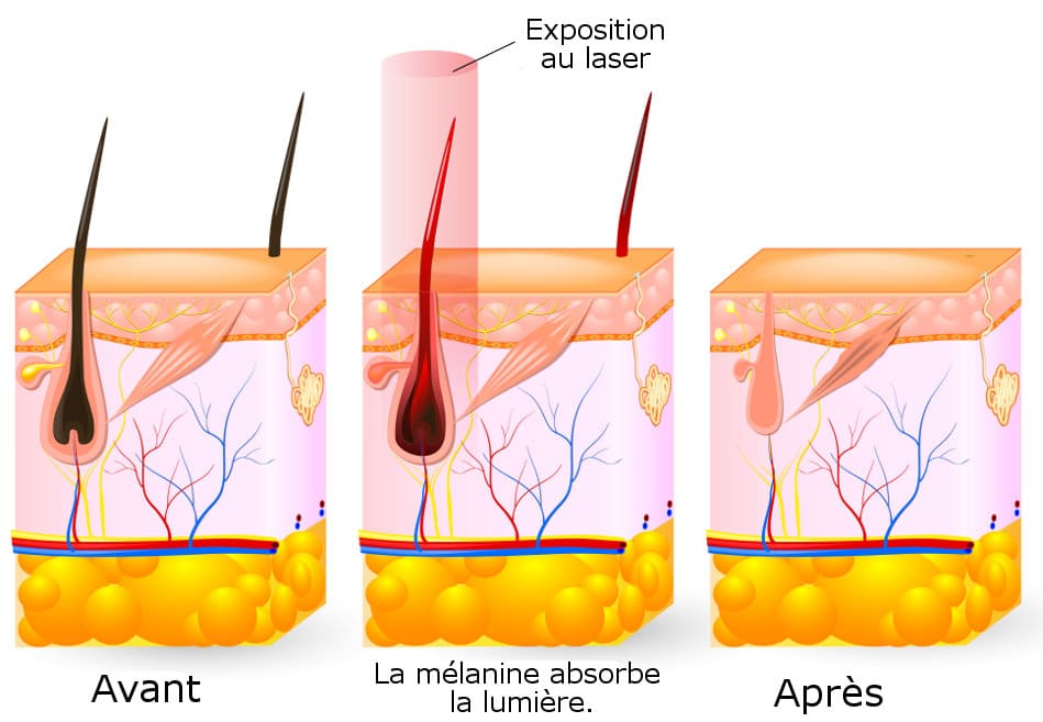Absorber la soif cristal epilation definitive effets indesirables Déjeuner Préposé Bande