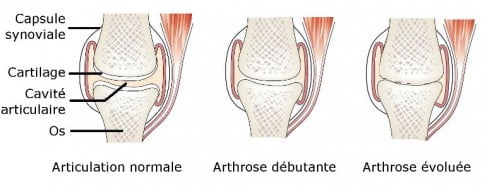 arthrose