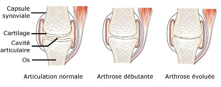 Arthrose : les articulations les plus touchées par l'arthrose - Arthrolink